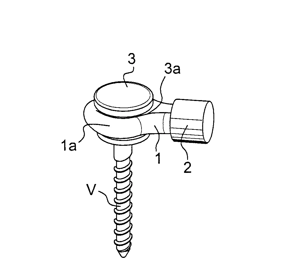 Dispositif extra- discal de stabilisation intervertebrale
