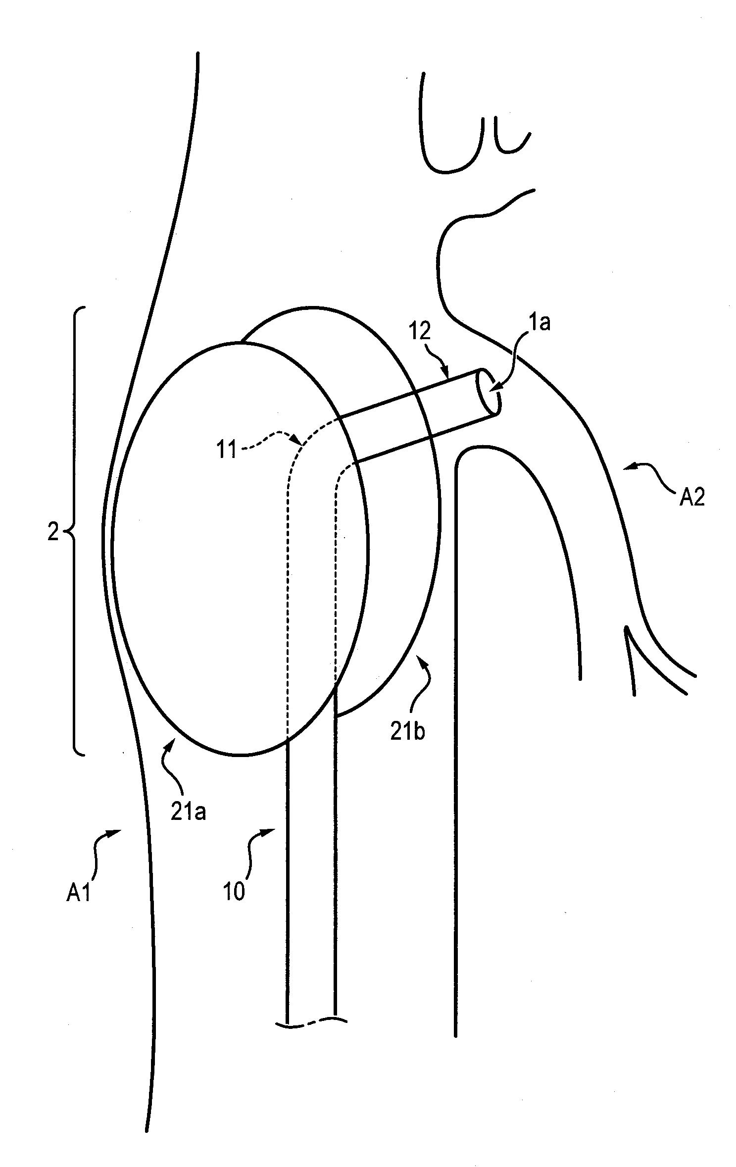Systeme d'introducteur pour catheterisme difficile