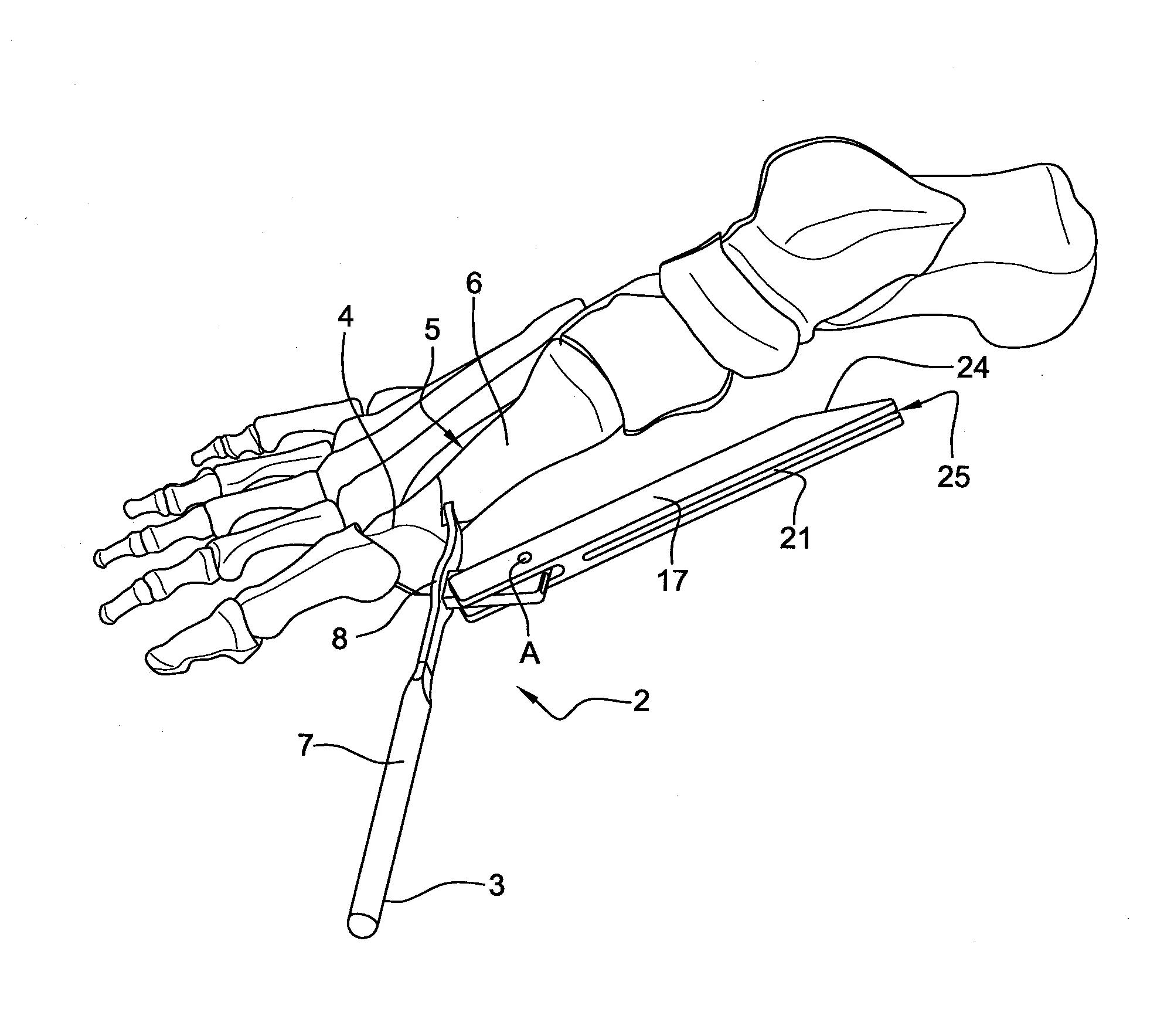 Ancillaire pour la correction d’un hallux valgus d’un patient